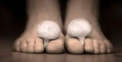 pés com cogumelos entre os dedos, simbolizando a infecção por fungos